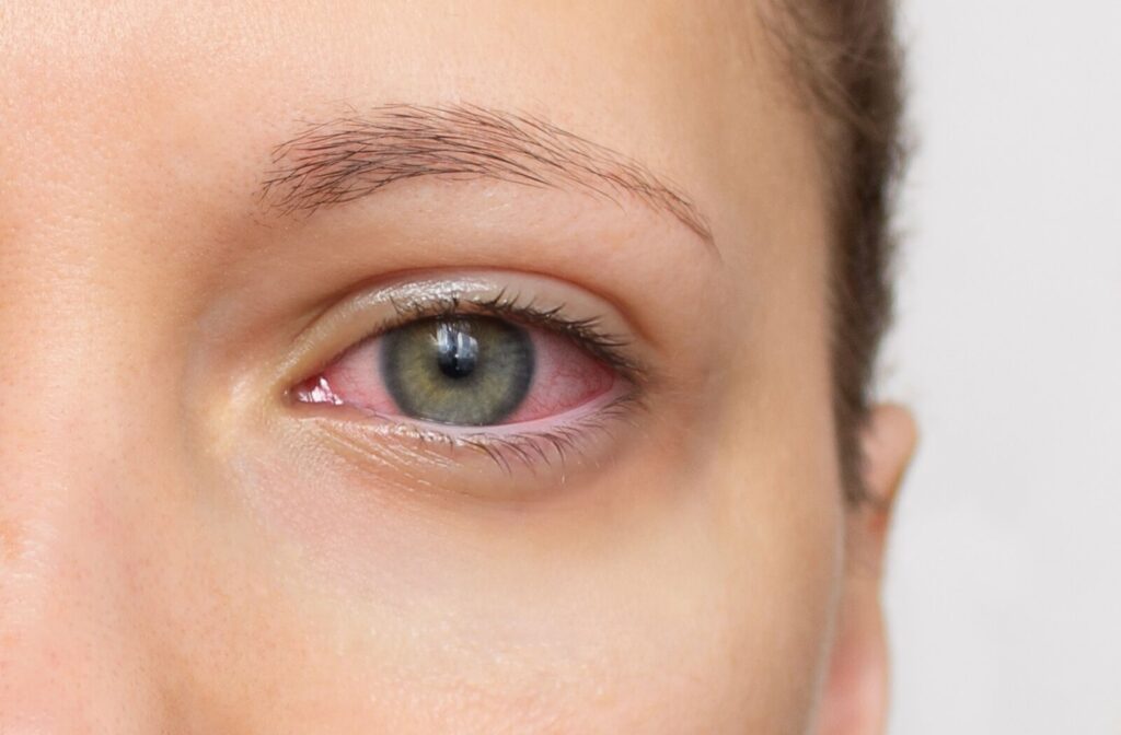 A close-up image of an adult's red, irritated eye from untreated dry eye syndrome.