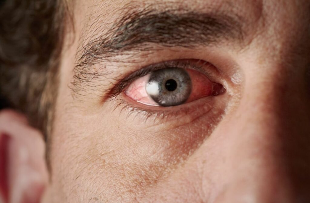 Close-up of an individual’s tired blue eye, bloodshot and red–symptoms of one several eye conditions, including pink eye