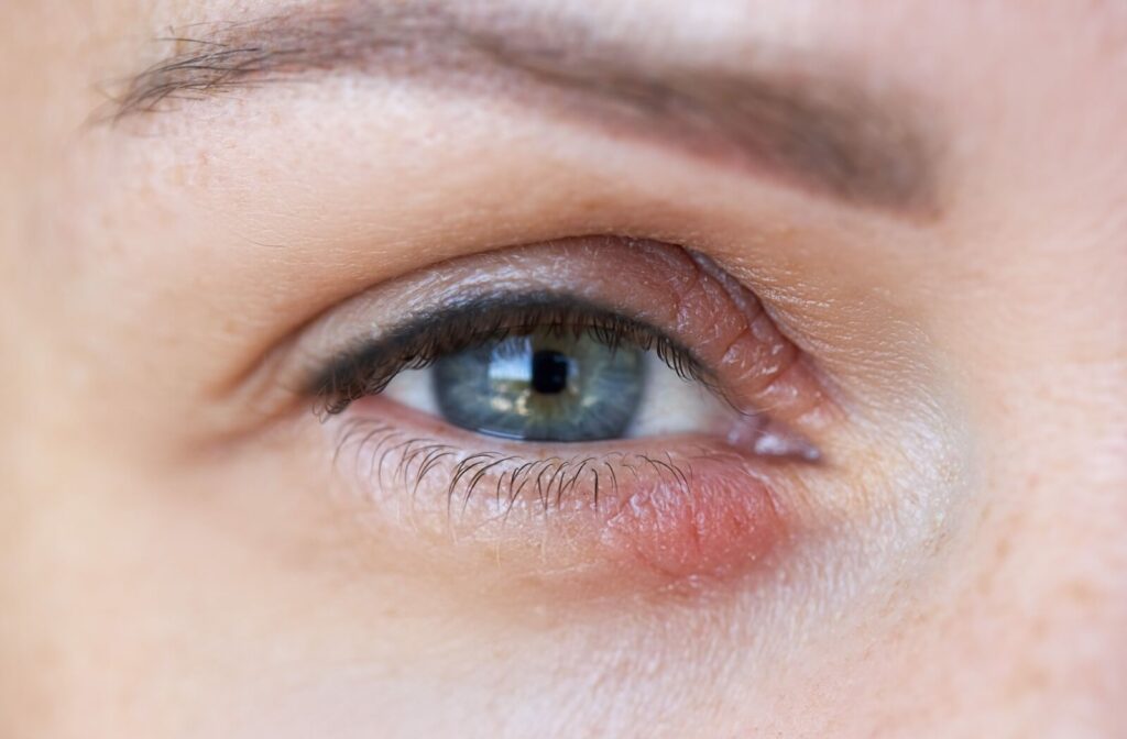 Close-up of an irritated eye showing redness along the eyelid, commonly associated with blepharitis symptoms.