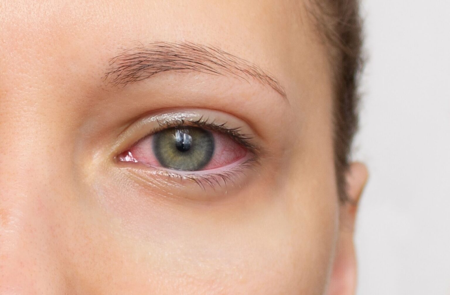 Pink Eye vs Allergies: How to Tell the Difference