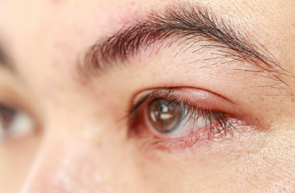 An extreme close-up of a person's eye featuring a small, red stye or bump on the upper eyelid, often associated with Meibomian Gland Dysfunction (MGD).